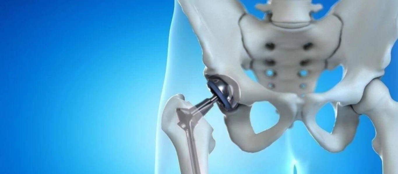 Oι βιταμίνες που αυξάνουν τον κίνδυνο κατάγματος του ισχίου